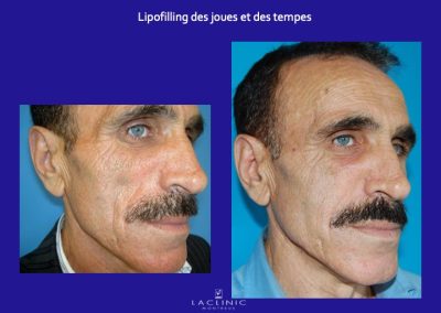 greffe adipocytaire lipodystrophie faciale