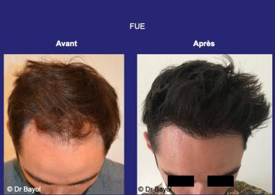 greffe cheveux FUE Lyon