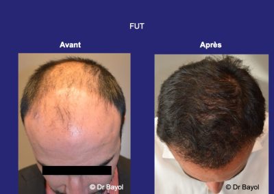 greffe cheveux FUT Lyon
