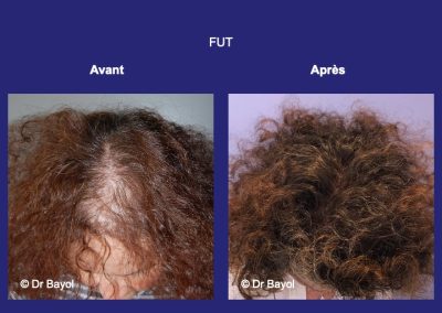 greffe cheveux femme Lyon