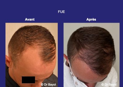 greffe de cheveux FUE Lyon
