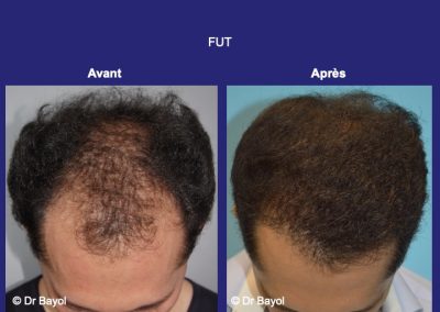 greffe de cheveux Lyon