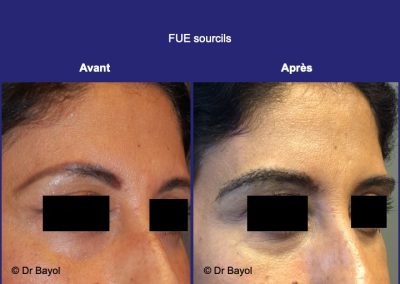 greffe sourcils Lyon