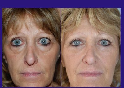 lifting centro-facial lyon
