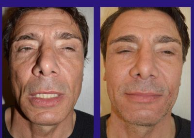 lifting centro facial lyon