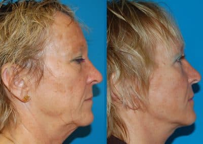 lifting cervico-facial