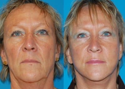 lifting cervico facial