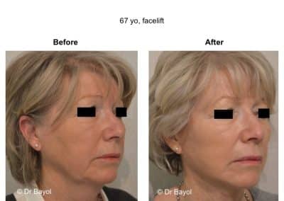 lifting cervico-facial à lyon