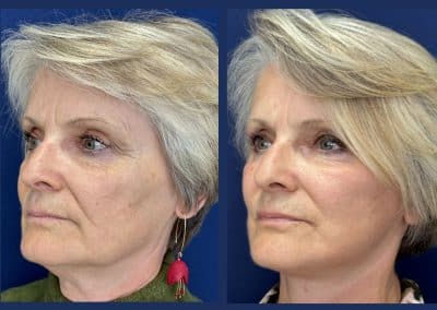 lifting cervico facial lyon