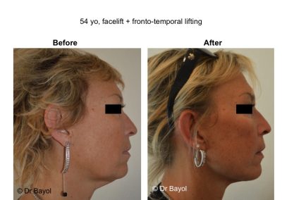 lifting fronto-temporal endoscopique lyon