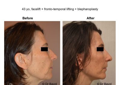 lifting fronto temporal lyon