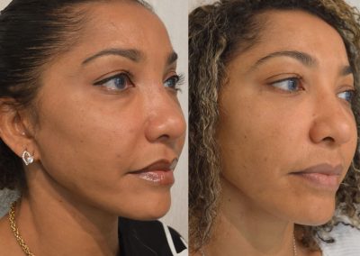 lifting médio facial lyon
