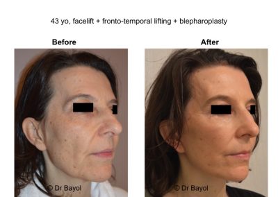 lifting temporal lyon