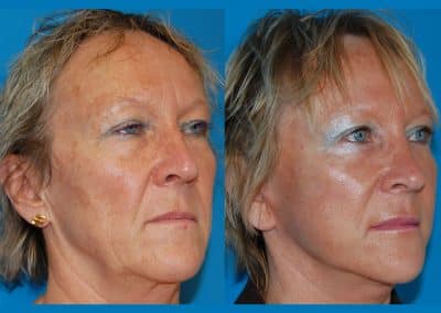 lifting visage