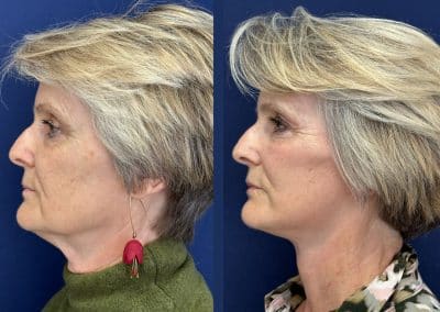 lifting visage lyon