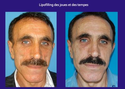 greffe adipocytaire lyon
