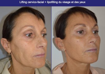 lipofilling lyon