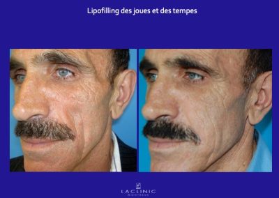 lipostructure lipodystroophie faciale