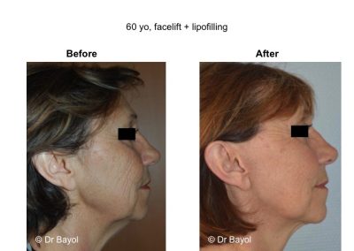 lipostructure visage lyon