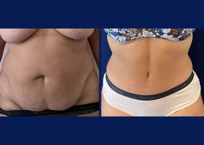 lyon abdominoplastie