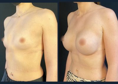 lyon augmentation mammaire implants