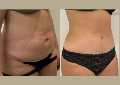 lyon chirurgie esthetique ventre