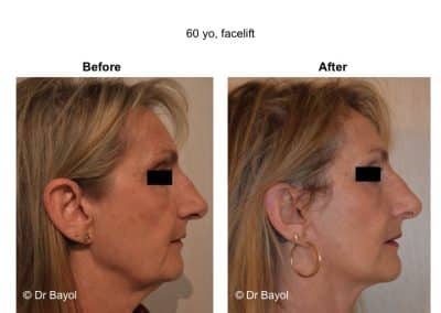 lyon lifting cervico-facial