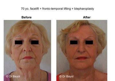 lyon lifting frontal