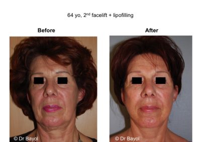lyon lipofilling visage