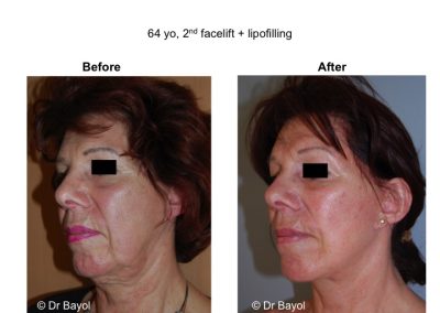 lyon lipostructure visage