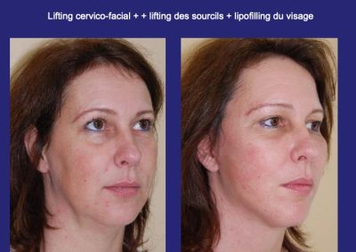 lyon nano lipofilling visage