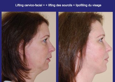 lyon nanolipofilling visage