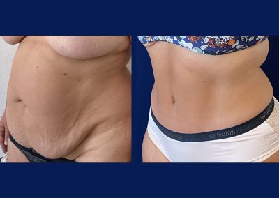 lyon plastie abdominale