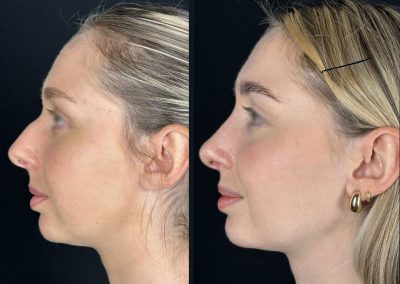 lyon rhinoplastie