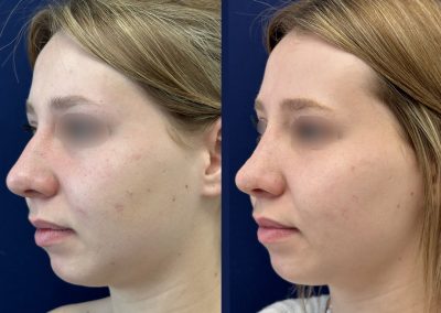 lyon rhinoplasty