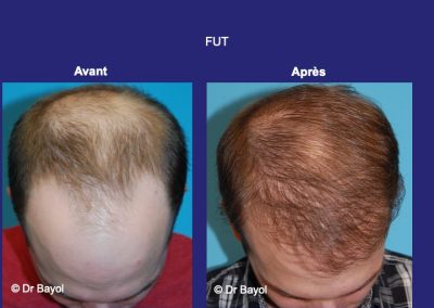 micro greffe de cheveux