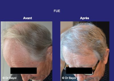 micro greffe de cheveux FUE Lyon