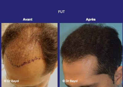 micro greffe de cheveux Lyon