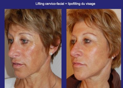 nano lipofilling lyon