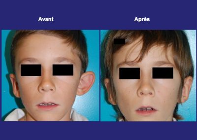 otoplastie