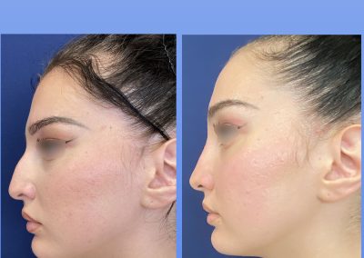 rhinoplastie