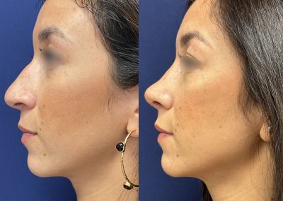 rhinoplastie ethnique lyon