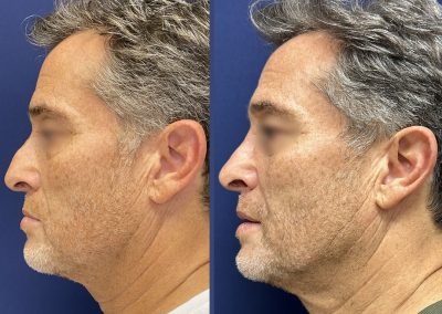 rhinoplastie post-traumatique lyon