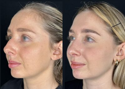 rhinoplastie post traumatique lyon