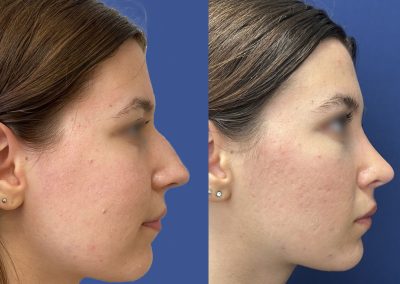 rhinoplastie preservation lyon