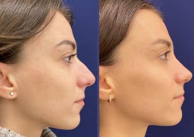 rhinoplastie préservation lyon