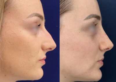 rhinoplastie ultra-sonique lyon