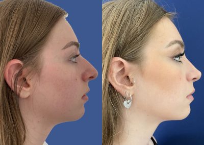 rhinoplastie de préservation lyon