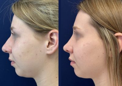 rhinoplasty lyon