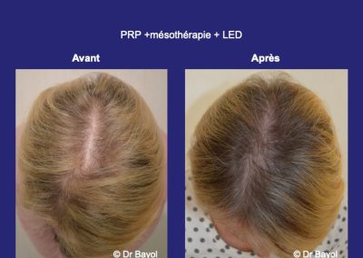 soins LED cheveux Lyon